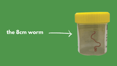 A live worm has been found in a NSW woman’s brain in a world first